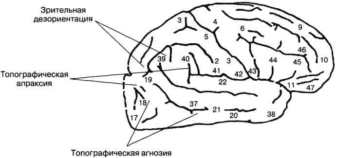 Нарушение схемы тела наблюдается при следующем виде агнозии