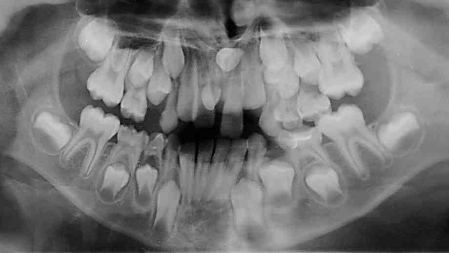 Рентген детских зубов фото