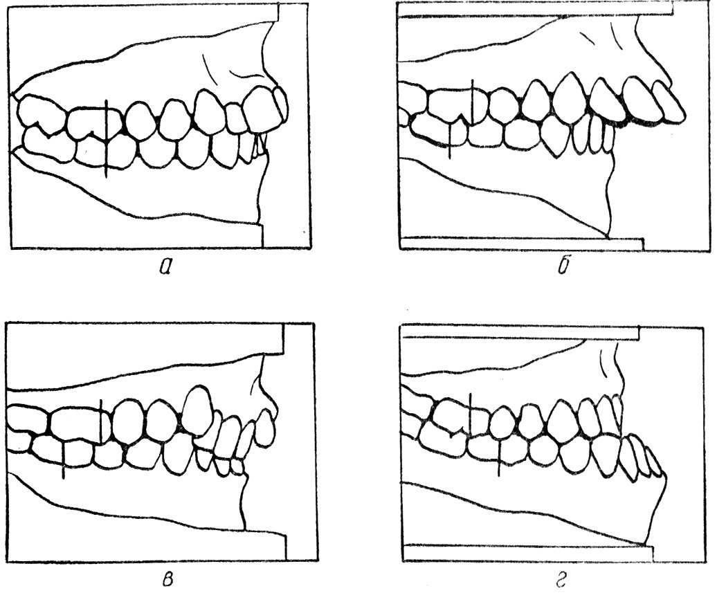 Нарушение окклюзии. Прикус 2 класс по Энглю. Бипрогнатический дистальный прикус. Классификация аномалий зубочелюстной системы. Классификация зубочелюстных аномалий по e. h. anglе..