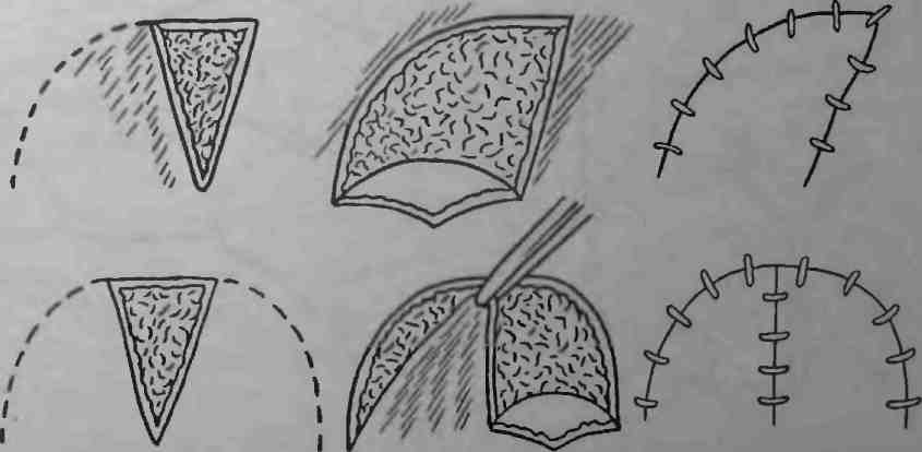 Пластика кожи. Кожная пластика по Красовитову. Рис. 17.2. Кожная пластика мостовидным лоскутом. Свободная кожная пластика по Красовитову. Несвободная кожная пластика местными тканями.